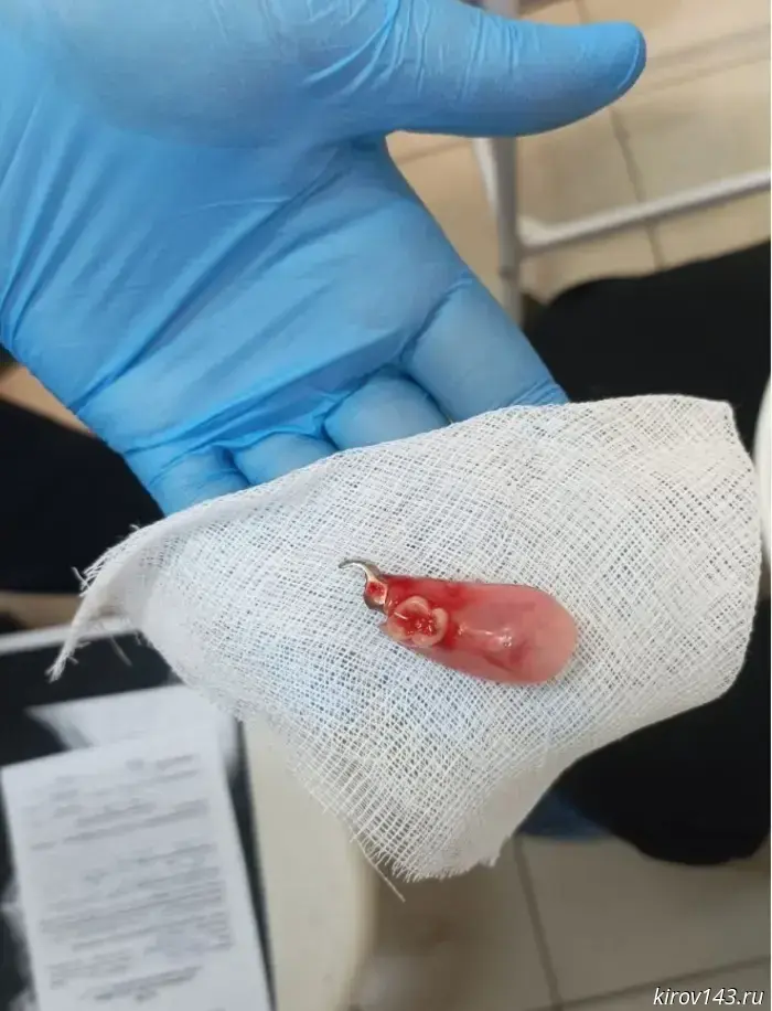 In Kirov, doctors removed a dental prosthesis from a patient's throat.