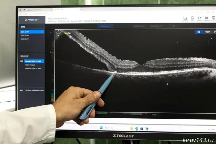 In Kirov, doctors saved the vision of a 65-year-old woman with a retinal detachment.