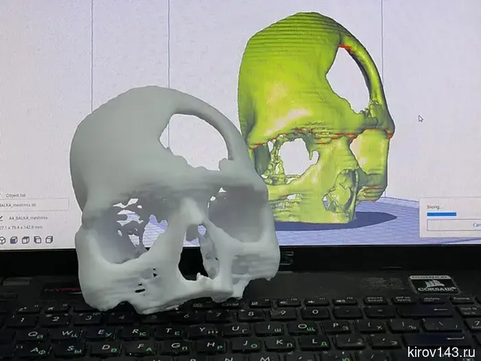 Kirov doctors are printing bones for complex surgeries.
