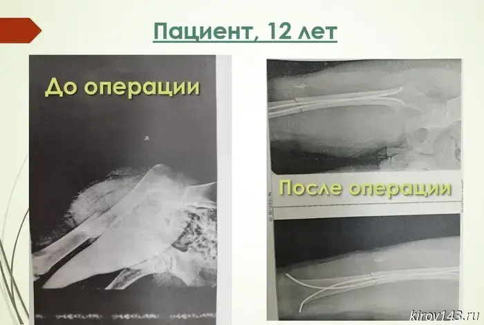 В Кирове медики спасли двоих подростков после серьёзных дорожно-транспортных происшествий.