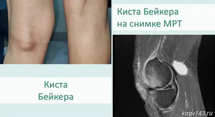 У жительницы Кирово-Чепецка обнаружили кисту размером шесть сантиметров в области колена.