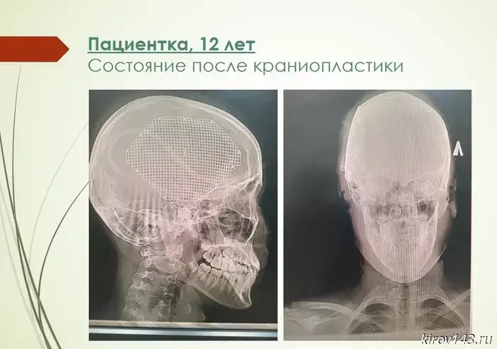 A 12-year-old girl who fractured her skull in a motorcycle accident was given a titanium plate.