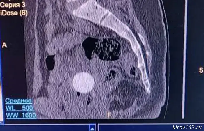 Doctors in Kirov removed a rubber ball from an 11-year-old girl.