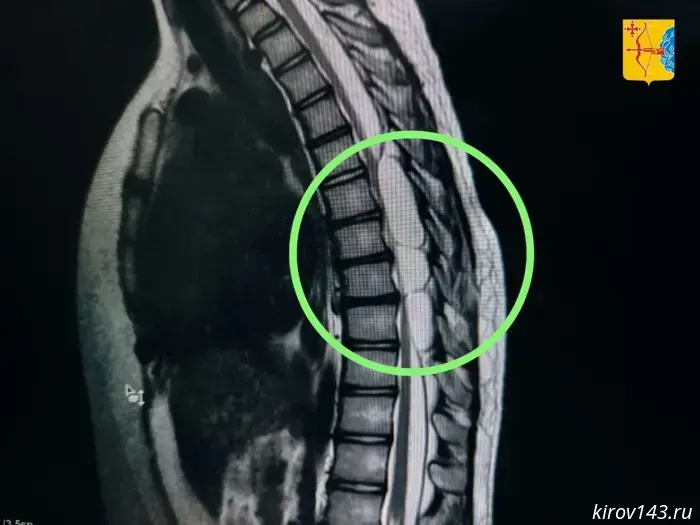 Kirov doctors performed a complex operation on the spine of a 14-year-old girl