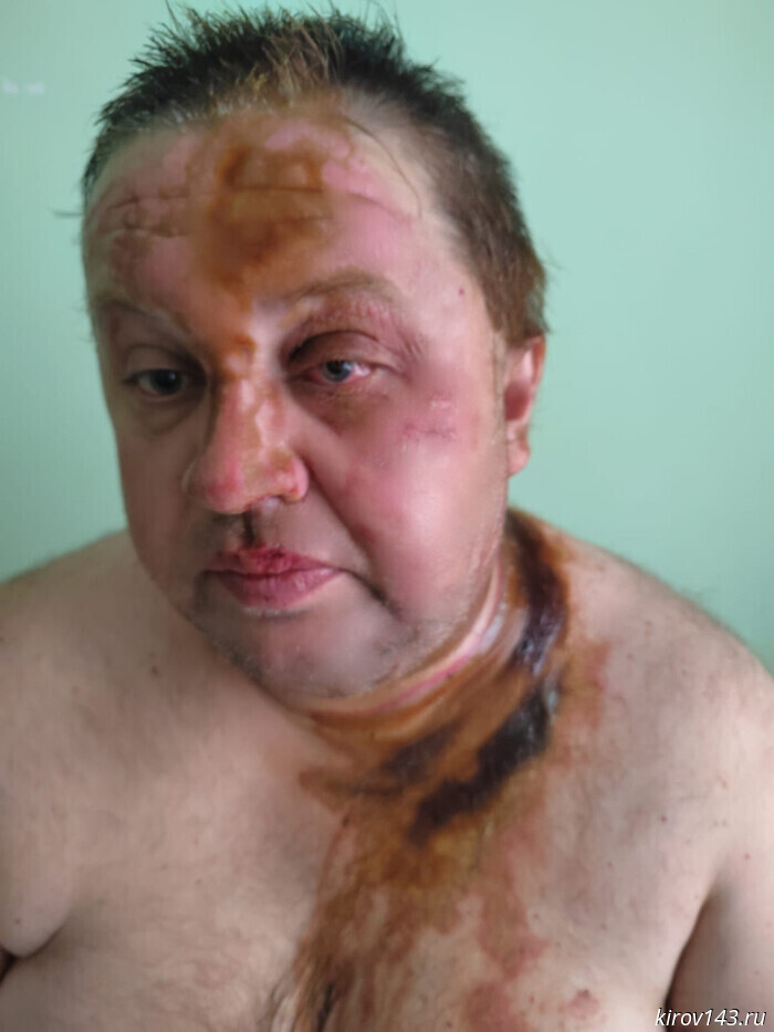 Igor Ronzhin, beaten in August, is undergoing treatment; the investigation into the assassination attempt continues.